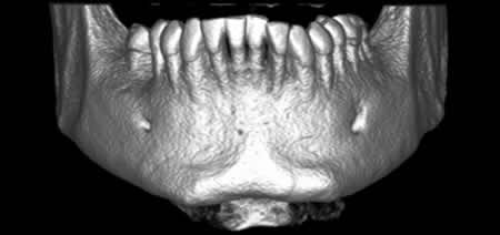 Mandíbula 3D Curso Practico de Cirugía Oral